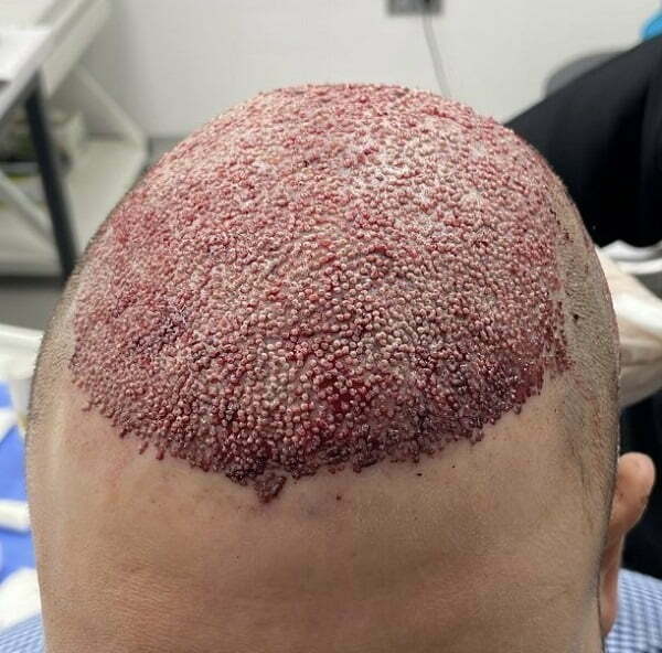 trapianto di capelli